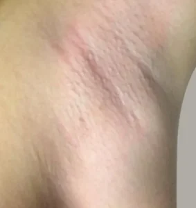 Результат після обробки апаратом для електроепіляції