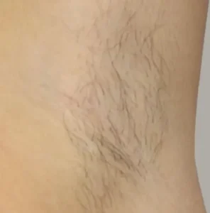 до процедури електроепіляції в зоні пахви